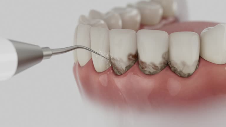 Trusted Wisdom Tooth Removal service in Elsmere, DE - Dentist Open Now